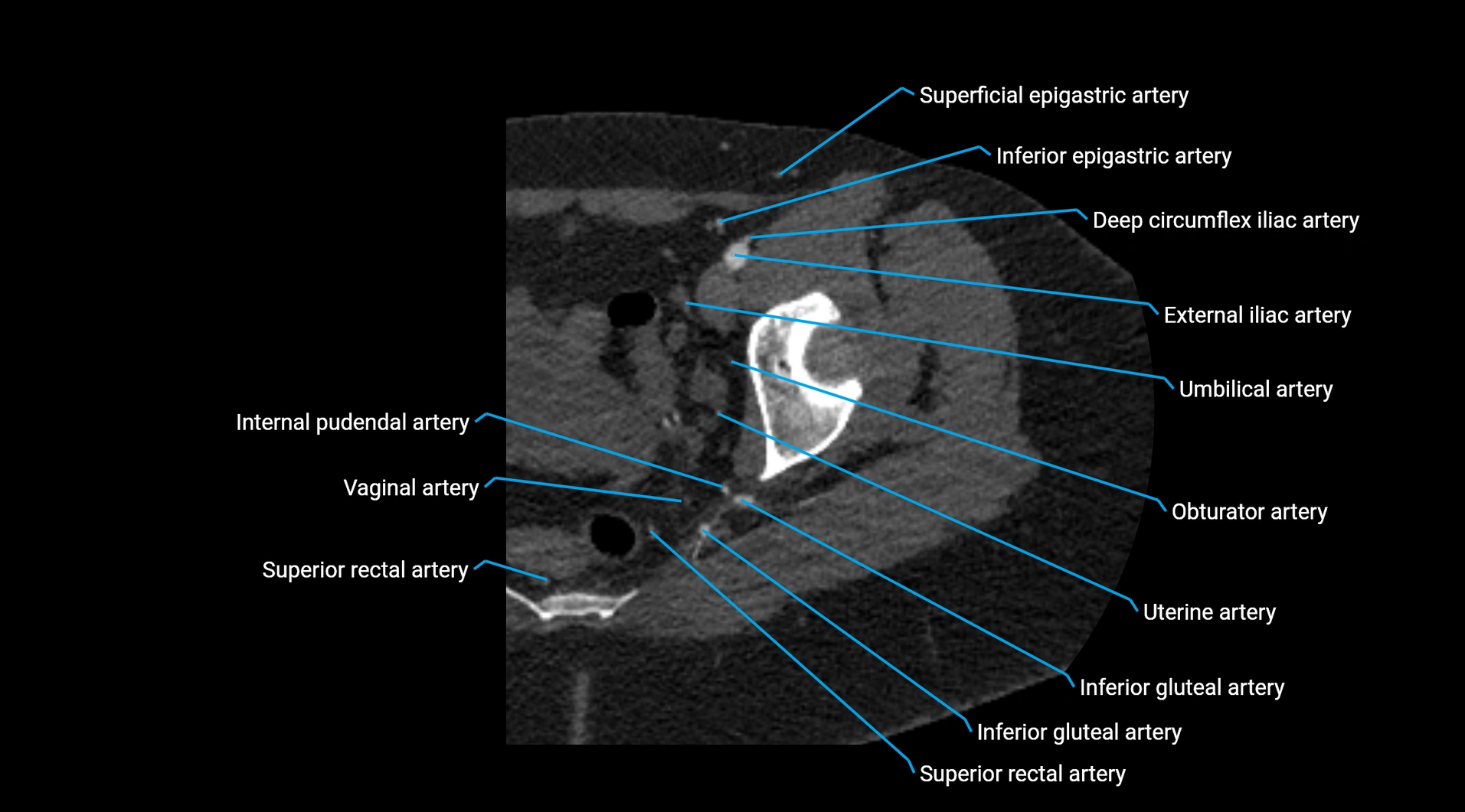 CTA lower limb cross sectional anatomy labelled image _48.webp